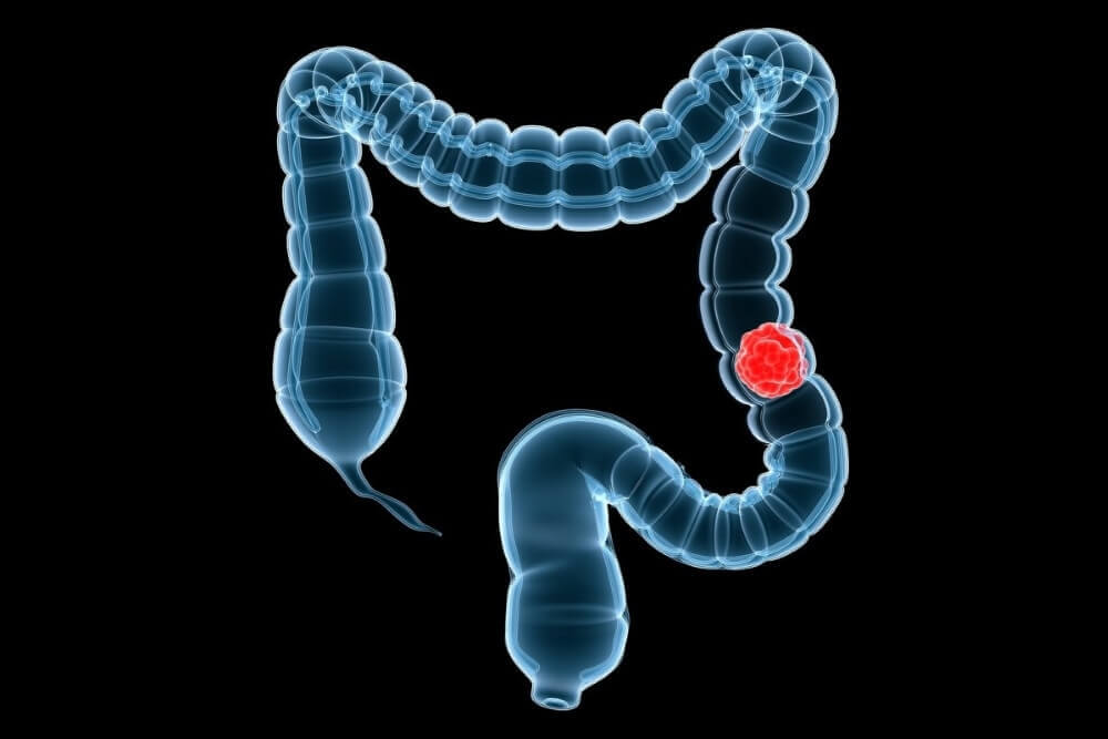Скрининг рака толстой кишки